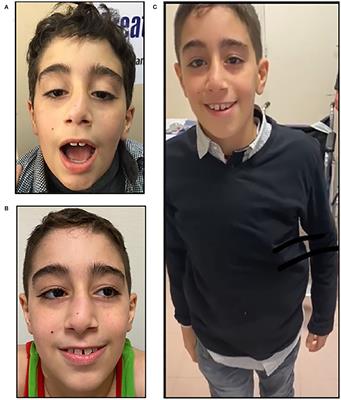 Case Report: A Novel AChR Epsilon Variant Causing a Clinically Discordant Salbutamol Responsive Congenital Myasthenic Syndrome in Two Egyptian Siblings